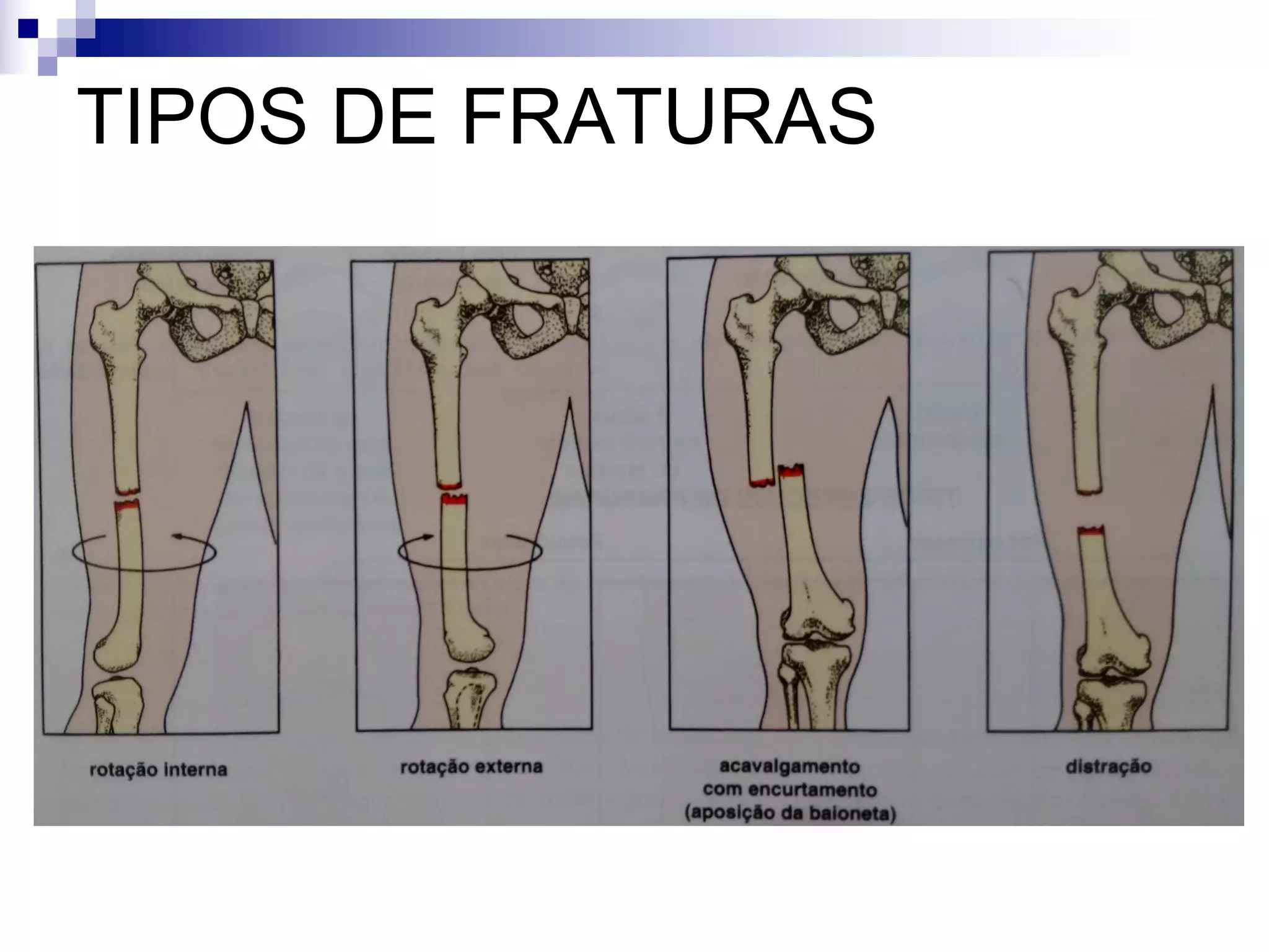 Aula 3 - Anatomia Radiologica Fratura.pdf