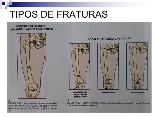 Aula 3 - Anatomia Radiologica Fratura.pdf