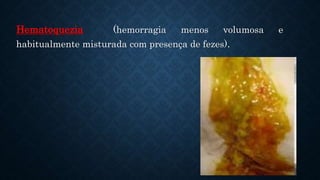 Hematoquezia (hemorragia menos volumosa e
habitualmente misturada com presença de fezes).
 