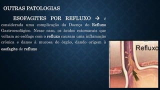 OUTRAS PATOLOGIAS
ESOFAGITES POR REFLUXO  é
considerada uma complicação da Doença do Refluxo
Gastroesofágico. Nesse caso, os ácidos estomacais que
voltam ao esôfago com o refluxo causam uma inflamação
crônica e danos à mucosa do órgão, dando origem à
esofagite de refluxo
 