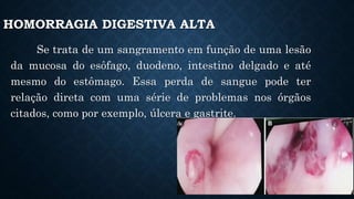 HOMORRAGIA DIGESTIVA ALTA
Se trata de um sangramento em função de uma lesão
da mucosa do esôfago, duodeno, intestino delgado e até
mesmo do estômago. Essa perda de sangue pode ter
relação direta com uma série de problemas nos órgãos
citados, como por exemplo, úlcera e gastrite.
 