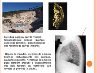 Ex: sílica, asbesto, carvão mineral.
Conseqüências:  silicose  (quartzo), 
asbestose (amianto), pneumoconiose 
dos minérios de carvão (mineral).
 Depois de inaladas. as fibras de amianto 
fixam-se  profundamente  nos  pulmões, 
causando cicatrizes. A inalação de amianto 
pode  também  produzir  o  espessamento 
dos  dois  folhetos  da  membrana  que 
reveste os pulmões (a pleura).
 