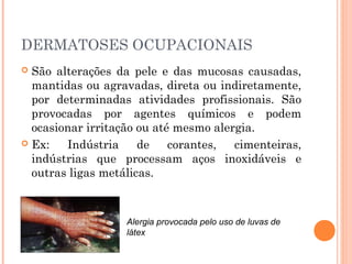 DERMATOSES OCUPACIONAIS 
 São alterações da pele e das mucosas causadas,
mantidas ou agravadas, direta ou indiretamente,
por determinadas atividades profissionais. São
provocadas por agentes químicos e podem
ocasionar irritação ou até mesmo alergia.
 Ex: Indústria de corantes, cimenteiras,
indústrias que processam aços inoxidáveis e
outras ligas metálicas.
Alergia provocada pelo uso de luvas de
látex
 