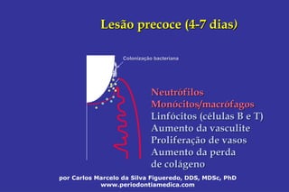 por Carlos Marcelo da Silva Figueredo, DDS, MDSc, PhD
www.periodontiamedica.com
Lesão precoce (4Lesão precoce (4--7 dias7 dias))
ColonizaColonizaçção bacterianaão bacteriana
NeutrNeutróófilosfilos
MonMonóócitos/macrcitos/macróófagosfagos
LinfLinfóócitos (ccitos (céélulas B e T)lulas B e T)
Aumento daAumento da vasculitevasculite
ProliferaProliferaçção de vasosão de vasos
Aumento da perdaAumento da perda
de colde coláágenogeno
 