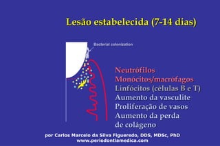 por Carlos Marcelo da Silva Figueredo, DDS, MDSc, PhD
www.periodontiamedica.com
Lesão estabelecida (7Lesão estabelecida (7--14 dias)14 dias)
Bacterial colonizationBacterial colonization
NeutrNeutróófilosfilos
MonMonóócitos/macrcitos/macróófagosfagos
LinfLinfóócitos (ccitos (céélulas B e T)lulas B e T)
Aumento daAumento da vasculitevasculite
ProliferaProliferaçção de vasosão de vasos
Aumento da perdaAumento da perda
de colde coláágenogeno
 