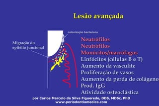 por Carlos Marcelo da Silva Figueredo, DDS, MDSc, PhD
www.periodontiamedica.com
Lesão avanLesão avanççadaada
colonizacolonizaçção bacterianaão bacteriana
NeutrNeutróófilosfilos
NeutrNeutróófilosfilos
MonMonóócitos/macrcitos/macróófagosfagos
LinfLinfóócitos (ccitos (céélulas B e T)lulas B e T)
Aumento daAumento da vasculitevasculite
ProliferaProliferaçção de vasosão de vasos
Aumento da perda de colAumento da perda de coláágenogeno
ProdProd.. IgGIgG
AtividadeAtividade osteoclosteocláásticastica
MigraMigraçção doão do
epitepitéélio juncionallio juncional
 