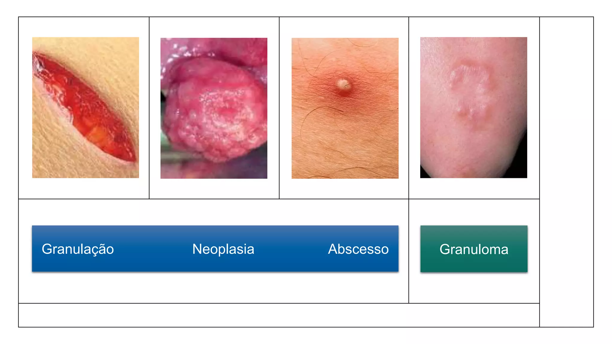 Granulação Neoplasia Abscesso Granuloma
 