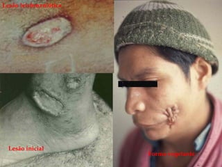 Forma vegetante
Lesão leishmaniótica
Lesão inicial
 