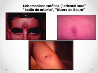 Leishmaniose cutânea (“oriental sore”
“botão do oriente”, “Úlcera de Bauru”
 
