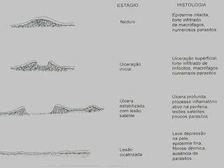 Evolução da Lesão Ulcerada naEvolução da Lesão Ulcerada na
LeishmanioseLeishmaniose
 