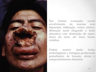 Nas formas avançadas ocorre
envolvimento da mucosa com
hiperemia, infltração, coriza crônica,
obstrução nasal chegando a lesão
ulcerativa com destruição do septo,
dorso do nariz até áreas faciais
vizinhas.
Podem ocorrer ainda lesões
orofaringianas e laríngeas produzindo
perturbações de fonação, afonia e
comprometimento alimentar.
 