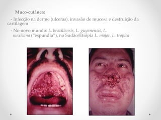 Muco-cutânea:
- Infecção na derme (ulceras), invasão de mucosa e destruição da
cartilagem
- No novo mundo: L. Pbraziliensis, PL. Pguyanensis, PL. P
 P P P P Pmexicana P(“espundia”), no Sudão/Etiópia L. Pmajor, PL. Ptropica
 