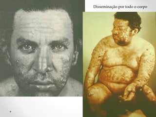 Disseminação por todo o corpo
 