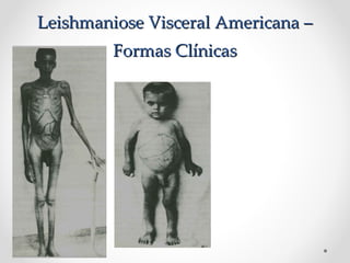 Leishmaniose Visceral Americana –Leishmaniose Visceral Americana –
Formas ClínicasFormas Clínicas
 