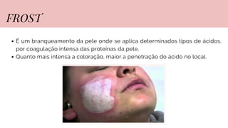 É um branqueamento da pele onde se aplica determinados tipos de ácidos,
por coagulação intensa das proteínas da pele.
Quanto mais intensa a coloração, maior a penetração do ácido no local.
FROST
 