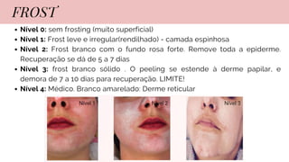Nível 0: sem frosting (muito superficial)
Nível 1: Frost leve e irregular(rendilhado) - camada espinhosa
Nível 2: Frost branco com o fundo rosa forte. Remove toda a epiderme.
Recuperação se dá de 5 a 7 dias
Nível 3: frost branco sólido . O peeling se estende à derme papilar, e
demora de 7 a 10 dias para recuperação. LIMITE!
Nível 4: Médico. Branco amarelado: Derme reticular
FROST
 