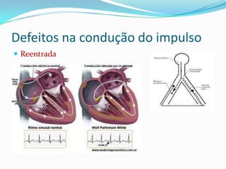 Defeitos na condução do impulso
 Reentrada

 