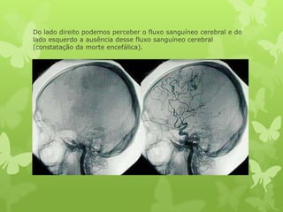 Do lado direito podemos perceber o fluxo sanguíneo cerebral e do
lado esquerdo a ausência desse fluxo sanguíneo cerebral
(constatação da morte encefálica).
 