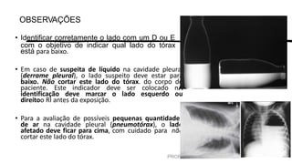 PROF. FERNANDA LIMA
OBSERVAÇÕES
• Identificar corretamente o lado com um D ou E
com o objetivo de indicar qual lado do tórax
está para baixo.
• Em caso de suspeita de líquido na cavidade pleural
(derrame pleural), o lado suspeito deve estar para
baixo. Não cortar este lado do tórax. do corpo do
paciente. Este indicador deve ser colocado nA
identificação deve marcar o lado esquerdo ou
direitoo RI antes da exposição.
• Para a avaliação de possíveis pequenas quantidades
de ar na cavidade pleural (pneumotórax), o lado
afetado deve ficar para cima, com cuidado para não
cortar este lado do tórax.
 
