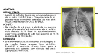 PROF. FERNANDA LIMA
ANATOMIA
DEMONSTRADA
• Ambos os pulmões devem ser incluídos dos ápices
até os seios costofrênicos. • Traqueia cheia de ar,
grandes vasos e contornos cardíacos são mais bem
visualizados na posição OAE a 60 graus.
POSIÇÃO
• Na rotação de 45 graus, a distância da margem
externa das costelas até a coluna vertebral no lado
mais afastado do RI deve ter aproximadamente
duas vezes a distância do lado mais próximo ao RI. RC
centralizado no nível da T7.
EXPOSIÇÃO
• Sem movimentação; os contornos do diafragma e
do coração devem aparecer bem definidos.
Exposição e contraste ótimos ideais para a
contornos das costelas, com exceção das áreas
superpostas ao coração.
 