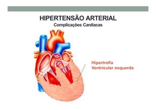 Hipertrofia
Ventricular esquerda
HIPERTENSÃO ARTERIAL
Complicações Cardíacas
 