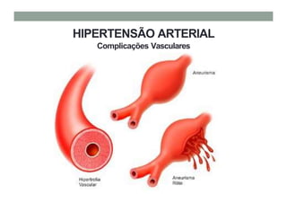 HIPERTENSÃO ARTERIAL
Complicações Vasculares
 
