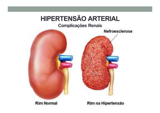 HIPERTENSÃO ARTERIAL
Complicações Renais
 