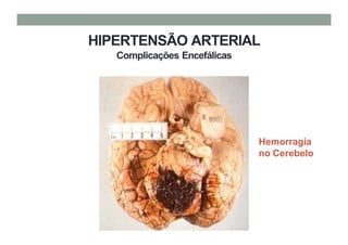 HIPERTENSÃO ARTERIAL
Complicações Encefálicas
Hemorragia
no Cerebelo
 