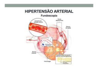HIPERTENSÃO ARTERIAL
Fundoscopia
 