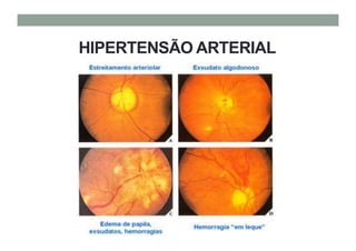 HIPERTENSÃO ARTERIAL
 