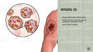 ▪ Reação inflamatória tuberculóide
▪ Ocorre necrose: desintegração da
epiderme e membrana basal
▪ Lesão ulcero-crostosa
 