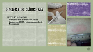 ▪ INFECÇÃO INAPARENTE
▪ Indivíduos sem manifestação clínica
▪ Apenas com IDRM – Intradermoreação de
Montenegro
 