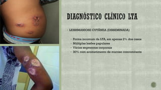 ▪ LEISHMANIOSE CUTÂNEA (DISSEMINADA)
▪ Forma incomum da LTA, em apenas 2% dos casos
▪ Múltiplas lesões papulares
▪ Vários segmentos corporais
▪ 30% com acometimento de mucoso concomitante
 