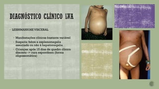 ▪ LEISHMANIOSE VISCERAL
▪ Manifestações clínicas bastante variável
▪ Suspeita: febre e esplenomegalia
associado ou não à hepatomegalia
▪ Crianças: após 15 dias de quadro clínico
discreto -> cura espontânea (forma
oligossomática)
 