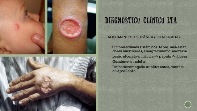Leishmaniose - Leishmania