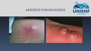 ABSCESOS FURUNCULOSOS
 