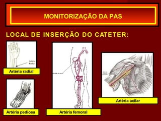 LOCAL DE INSERÇÃO DO CATETER:
MONITORIZAÇÃO DA PAS
Artéria radial
Artéria femoral
Artéria axilar
Artéria pediosa
 