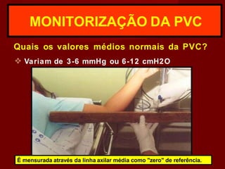 MONITORIZAÇÃO DA PVC
Quais os valores médios normais da PVC?
❖ Variam de 3-6 mmHg ou 6-12 cmH2O
É mensurada através da linha axilar média como "zero" de referência.
 