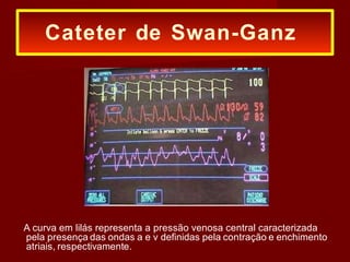 A curva em lilás representa a pressão venosa central caracterizada
pela presença das ondas a e v definidas pela contração e enchimento
atriais, respectivamente.
Cateter de Swan-Ganz
 