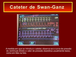 A medida em que se introduz o cateter,observa-se a curva de pressão
do ventrículo direito e valor de pressão diastólica usualmente baixo,
como em lilás na foto.
Cateter de Swan-Ganz
 