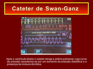Após o ventrículo direito o cateter atinge a artéria pulmonar, cuja curva
de pressão caracteriza-se por um aumento da pressão diastólica e a
presença da incisura dicrótica.
Cateter de Swan-Ganz
 