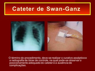O término do procedimento, deve-se realizar o curativo asséptico e
a radiografia de tórax de controle, na qual pode-se observar o
posicionamento adequado do cateter e a ausência de
complicações.
Cateter de Swan-Ganz
 