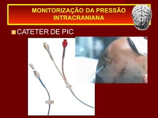 ■CATETER DE PIC
MONITORIZAÇÃO DA PRESSÃO
INTRACRANIANA
 