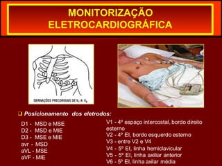 MONITORIZAÇÃO
ELETROCARDIOGRÁFICA
D1 - MSD e MSE
D2 - MSD e MIE
D3 - MSE e MIE
avr - MSD
aVL - MSE
aVF - MIE
❑ Posicionamento dos eletrodos:
V1 - 4º espaço intercostal, bordo direito
esterno
V2 - 4º EI, bordo esquerdo esterno
V3 - entre V2 e V4
V4 - 5º EI, linha hemiclavicular
V5 - 5º EI, linha axiliar anterior
V6 - 5º EI, linha axilar média
 