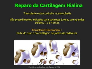 Reparo da Cartilagem Hialina
Transplante Osteocondral :
Parte do osso e da cartilagem de joelho de cadáveres
Transplante osteocondral e mosaicoplastia
São procedimentos indicados para pacientes jovens, com grandes
defeitos ( 1 a 4 cm2).
http://simonealberti.com.br/?page_id=116
 