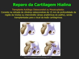 Reparo da Cartilagem Hialina
Transplante Autólogo Osteocondral ou Mosaicoplastia:
Consiste na retirada de cilindros osteocondrais de 15 mm de profundidade da
região da tróclea ou intercôndilo (áreas anatômicas do joelho), sendo
transplantadas para o local da lesão cartilaginosa.
http://simonealberti.com.br/?page_id=116
 