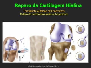 Reparo da Cartilagem Hialina
Transplante Autólogo de Condrócitos:
Cultivo de condrócitos sadios e transplante
http://simonealberti.com.br/?page_id=116
 