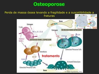 Osteoporose
Perda de massa óssea levando a fragilidade e a suscetibilidade a
fraturas
tratamento
 