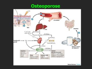 Osteoporose
 