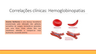 Correlações clínicas: Hemoglobinopatias
Anemia falciforme é uma doença hereditária
caracterizada pela alteração dos glóbulos
vermelhos do sangue, tornando-os parecidos
com uma foice, Essas células têm sua
membrana alterada e rompem-se mais
facilmente, causando anemia
 